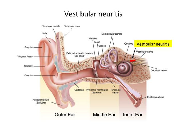 vestibular neuronitis