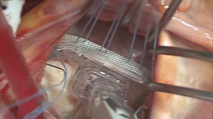 Double Valve Repair for Marfan Aortic Root Aneurysm and Bileaflet (Barlow’s) Mitral Valve