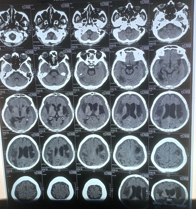 An interesting CT Brain finding