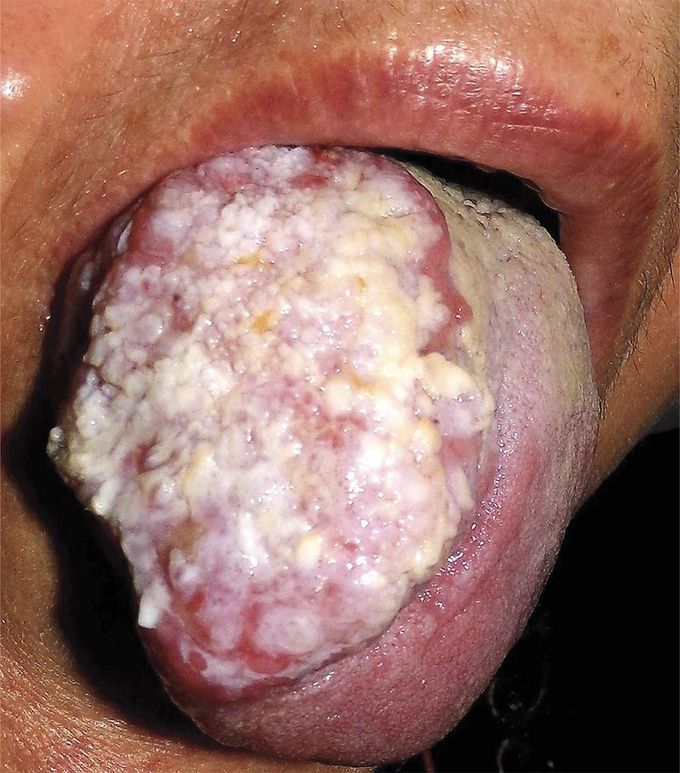 Verrucous Tongue Lesion
