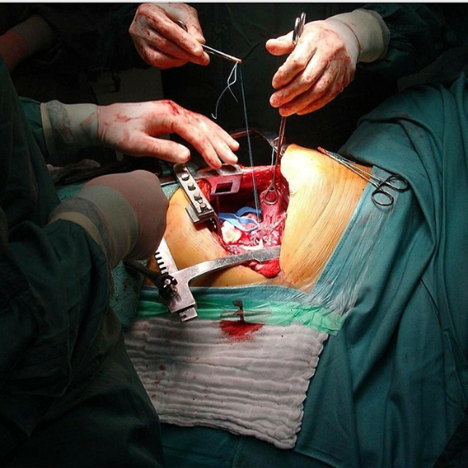 Lung lobectomy