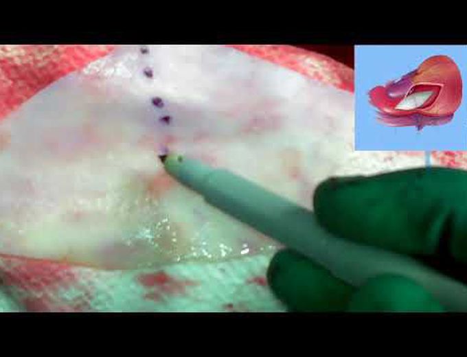 Konno-Rastan Aortoventriculoplasty for Aortic Valve Replacement