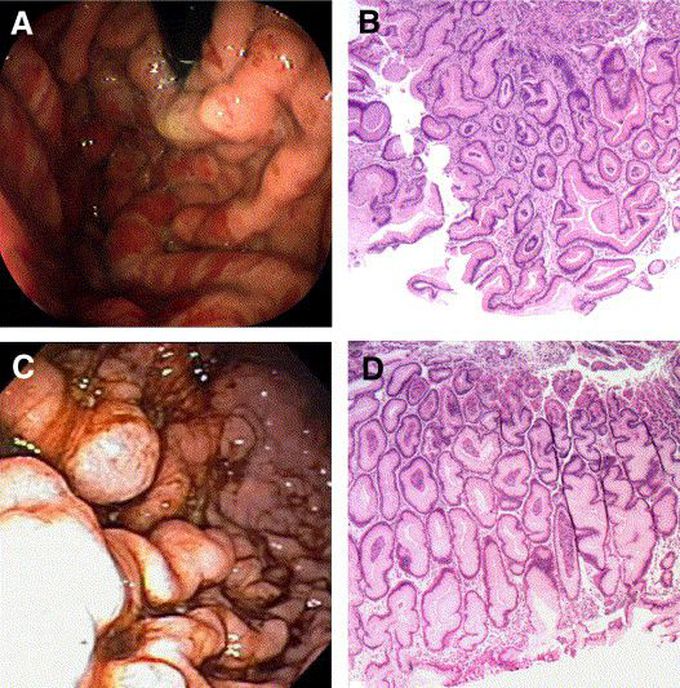 Menetrier's Disease