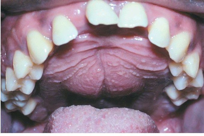 Hyperparathyroidism