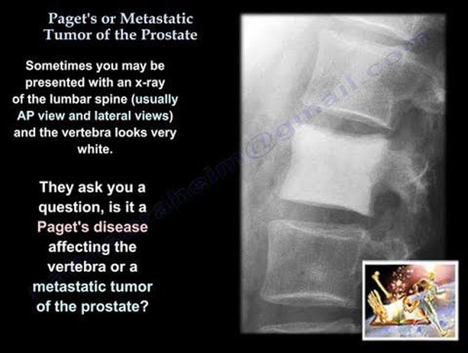 Paget's Or Metastatic Tumor Of The Prostate - Everything You Need To Know - Dr. Nabil Ebraheim
