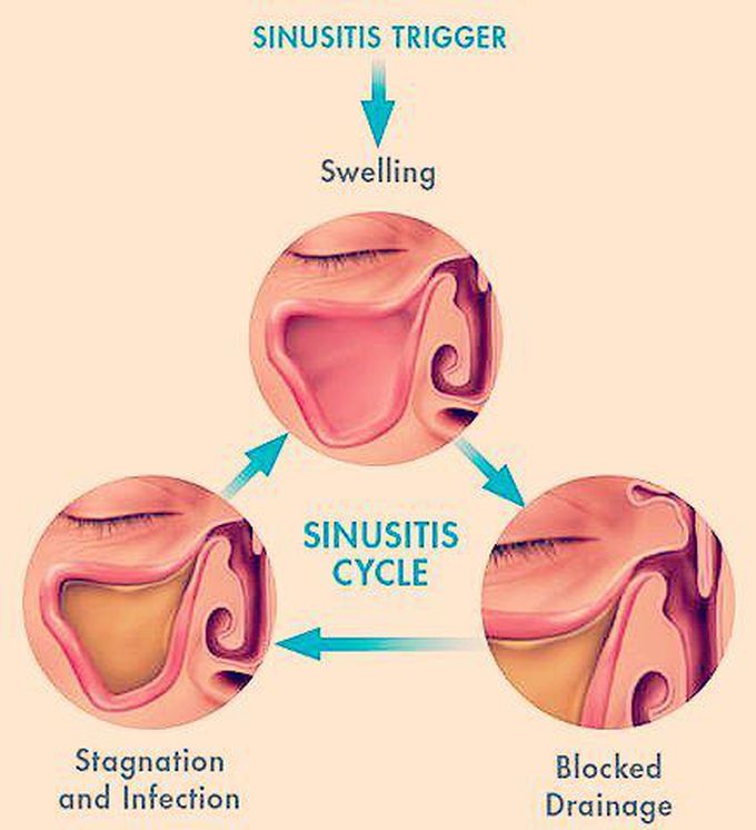 Sinusitis Medizzy