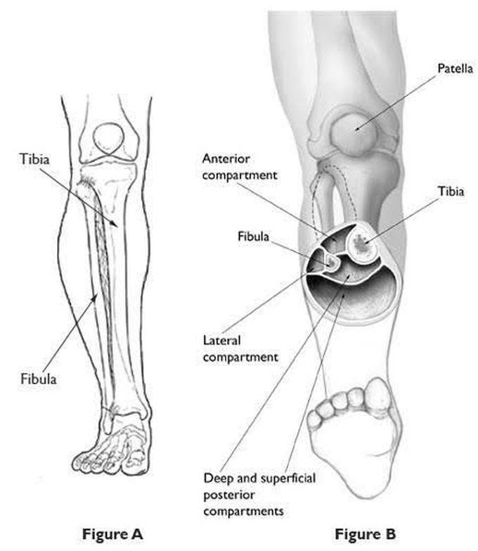 Compartment syndrome