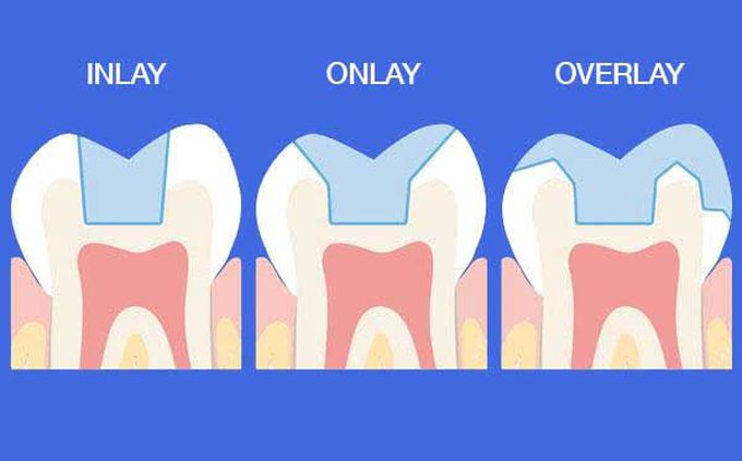 Inlay vs onlay vs overlay