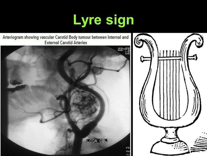 Carotid body tumor -lyre sign