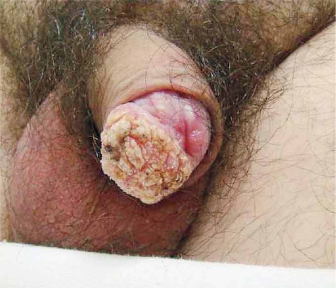 Squamous-Cell Carcinoma of the Penis with Human Papillomavirus