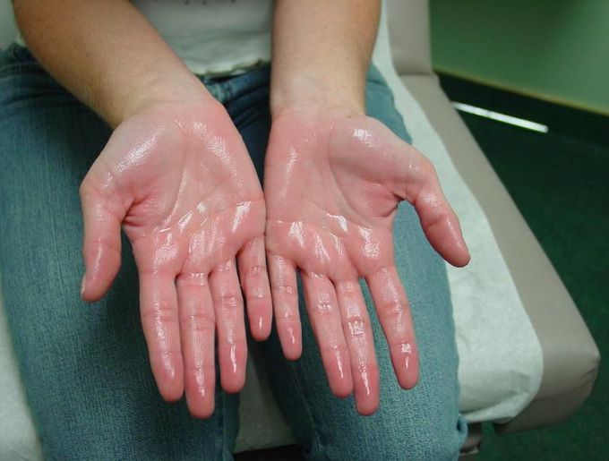 HYPERHIDROSIS