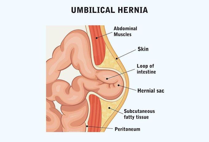 Para umbilical hernia examination
