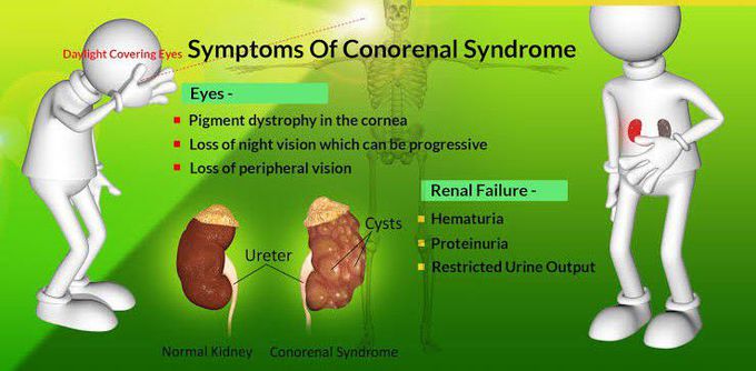 These are the symptoms of Conorenal syndrome