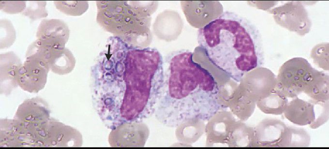 Disseminated Histoplasmosis