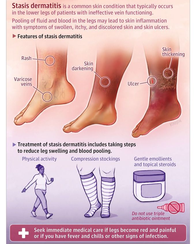 Stasis Dermatitis