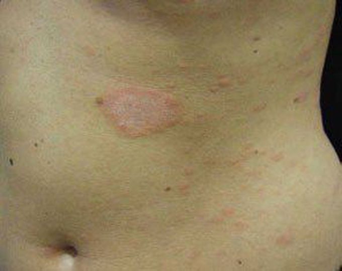 Pityriasis rosea