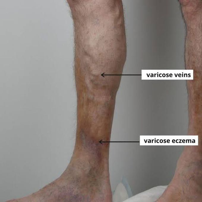 Clinical features of varicose eczema