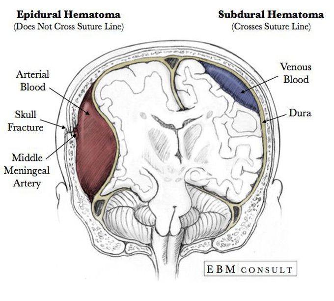 Epidural Hematoma vs. Subdural Hematoma