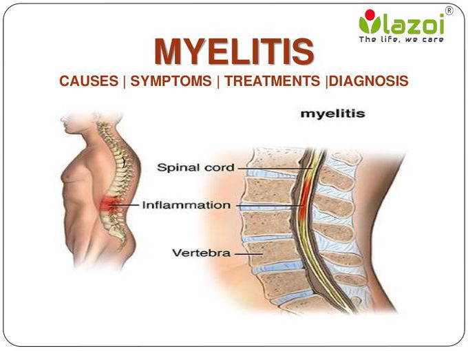 Transverse Myelitis