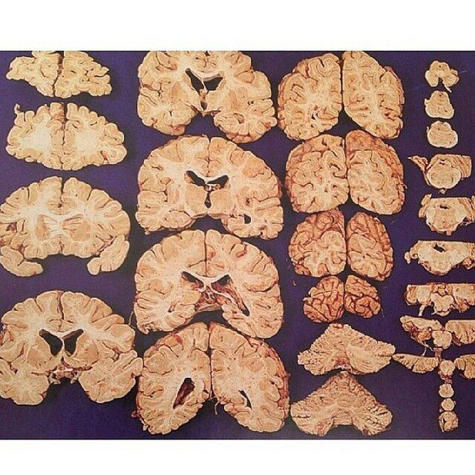 coronal brain