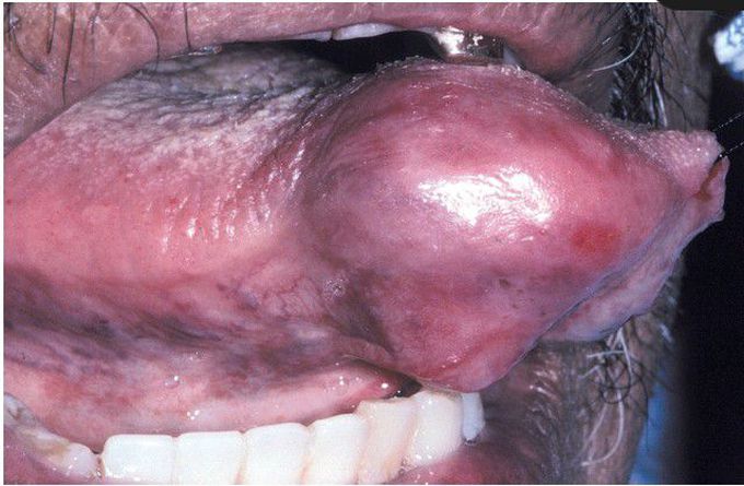 Mucoepidermoid Carcinoma.