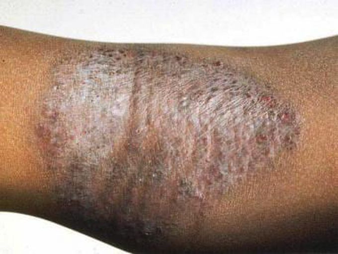 Hidradenitis Suppurativa (HS)