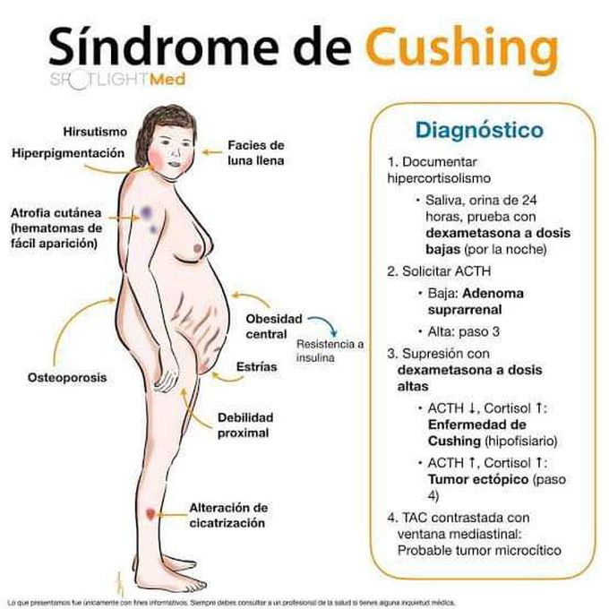 Sindrome Cushing