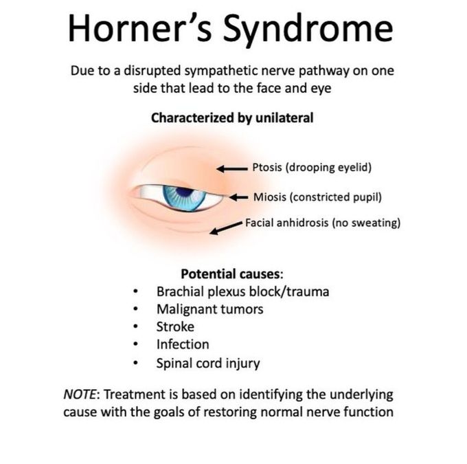 Horner Syndrome