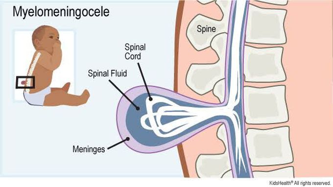 causes of myelomeningocele