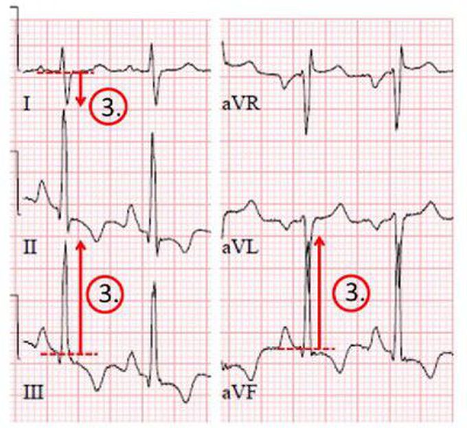 Axis  deviation
