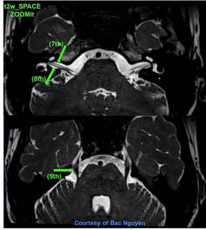 Internal Auditory Canal (IAC) @ Siemens 3T Prisma. ZOOMit - MEDizzy