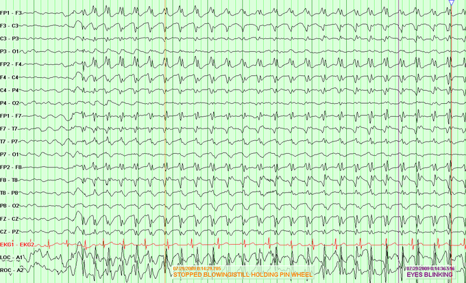 EEG Pattern in Absence Seizure