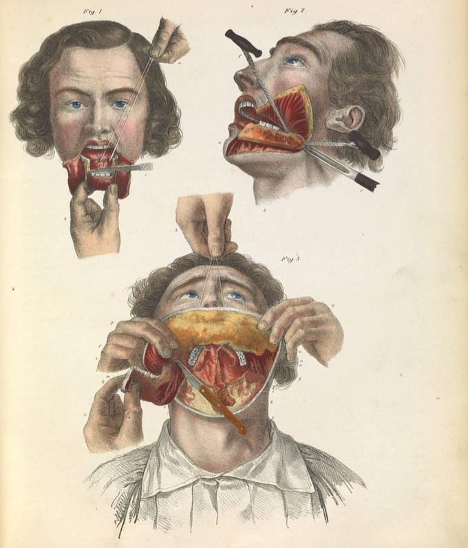 Malignant tumor removal