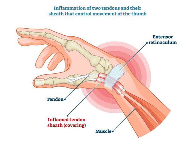 De Quervian Tenosynovitis