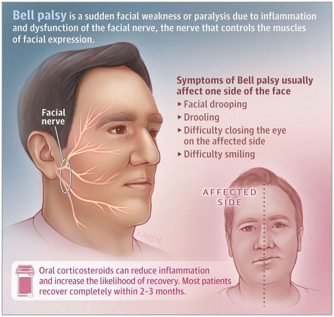 Bell's Palsy