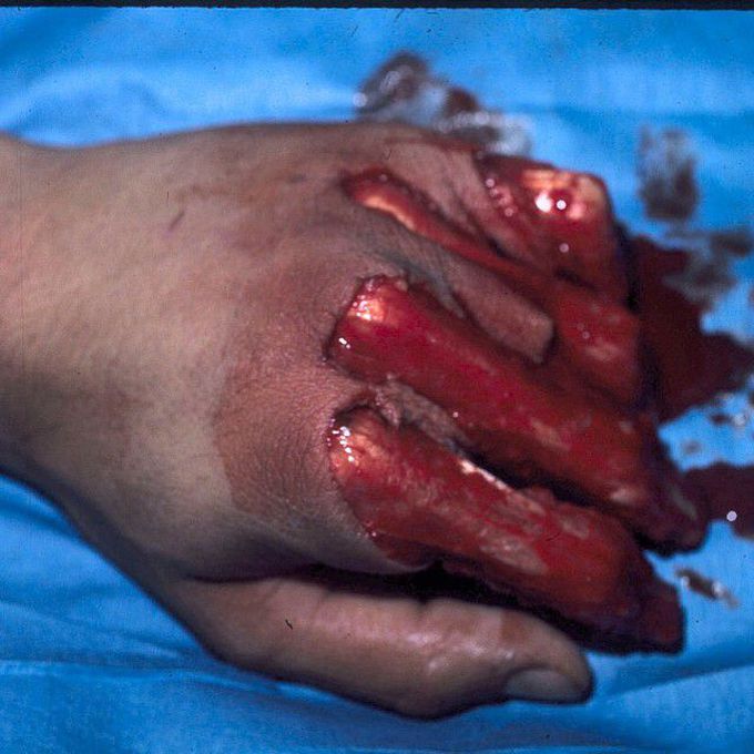 Severe degloving hand injury