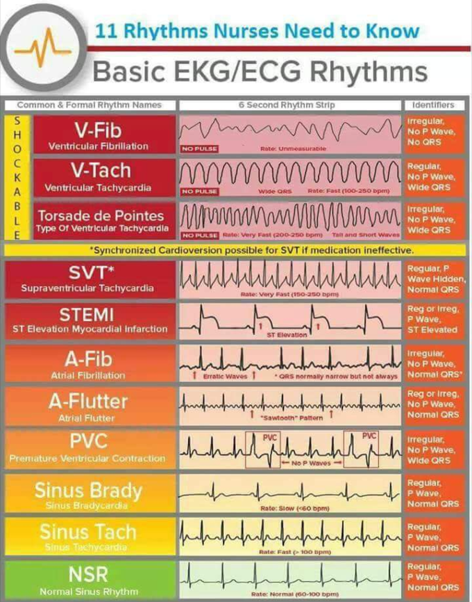 Basic Ecg Rhythms Medizzy