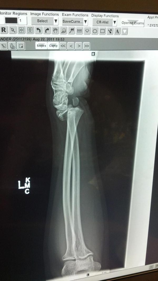Football injury. Fractured and dislocated wrist