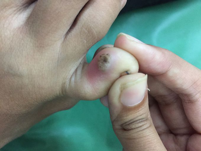 Plantar Wart