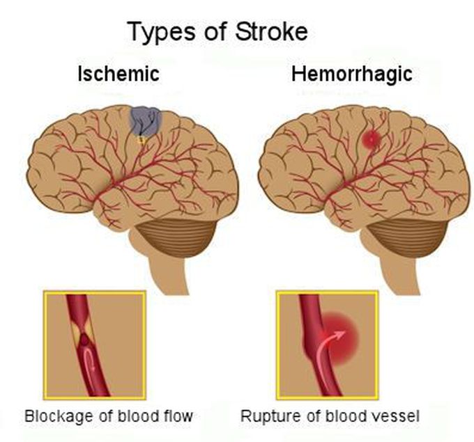 Types of storke
