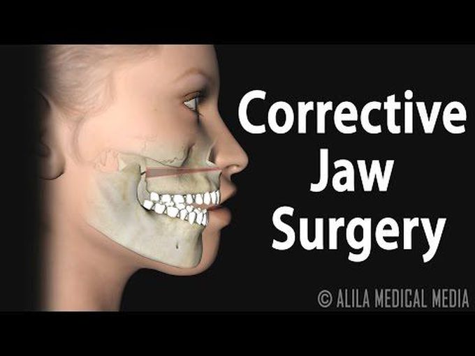 Orthognathic Surgery - 3D animation