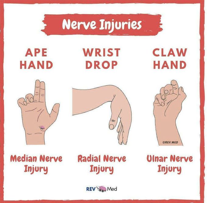 Nerve injures