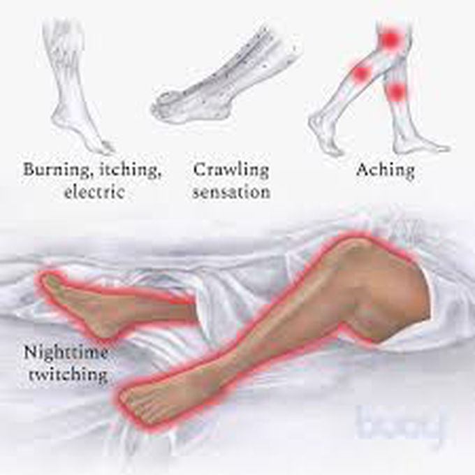 What is Ekbom syndrome