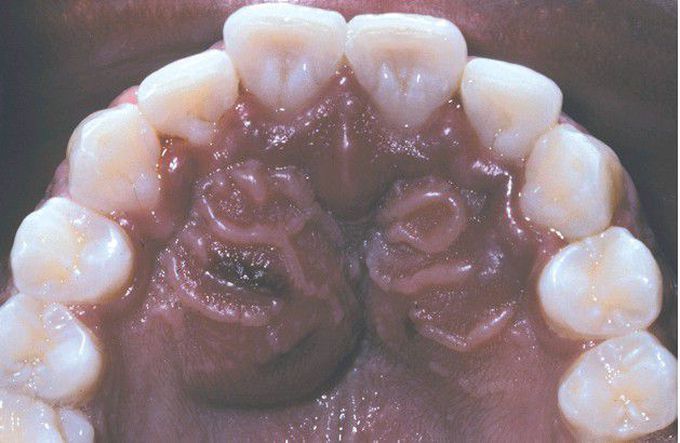 Periapical Abscess