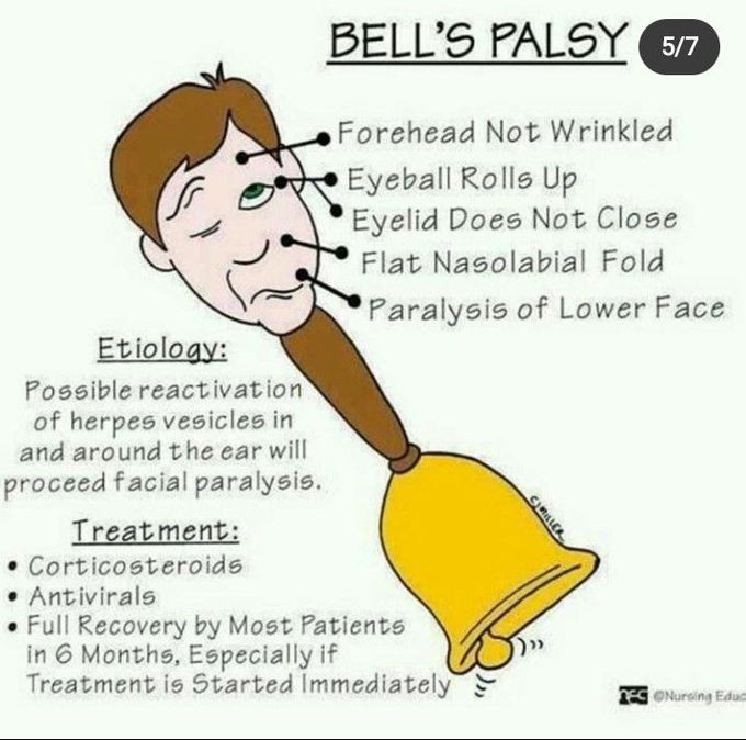 Bell's palsy