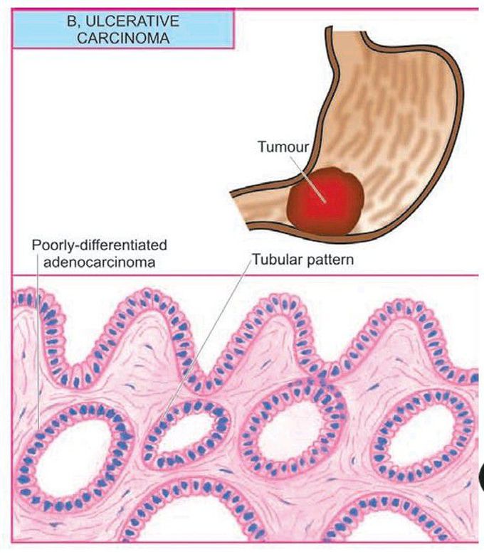 Gastric carcinoma