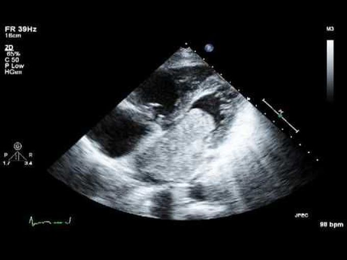 Atrial Myxoma As Seen Of Transesophageal Echocardiography