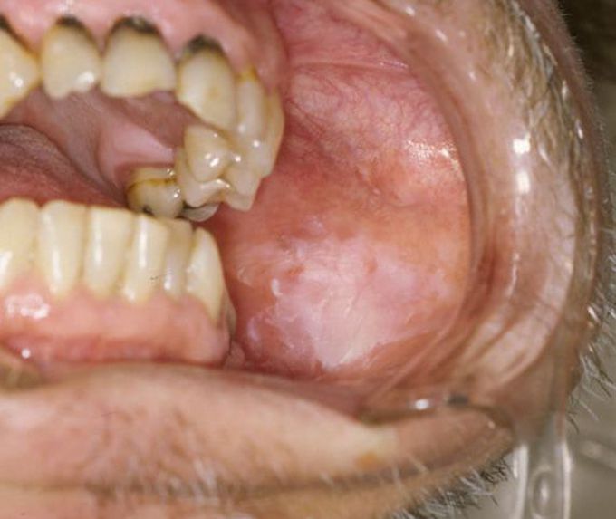 Leukoplakia- Causes and Risk Factors