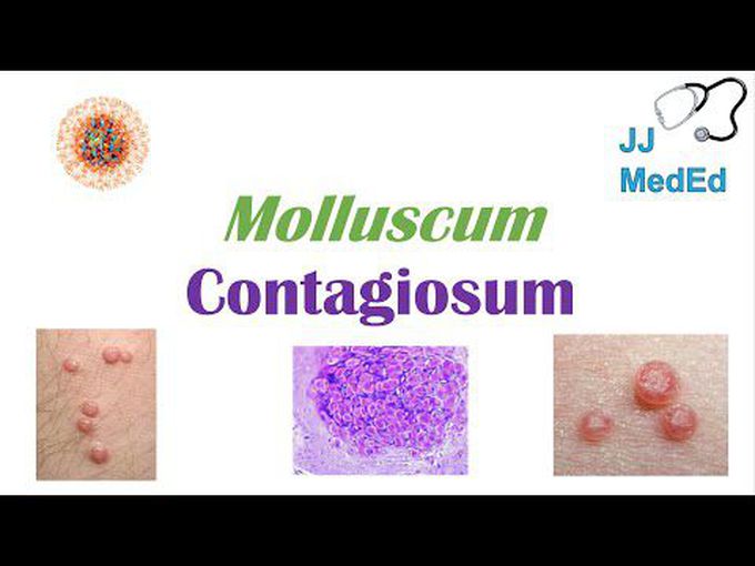 Molluscum contagiosum
