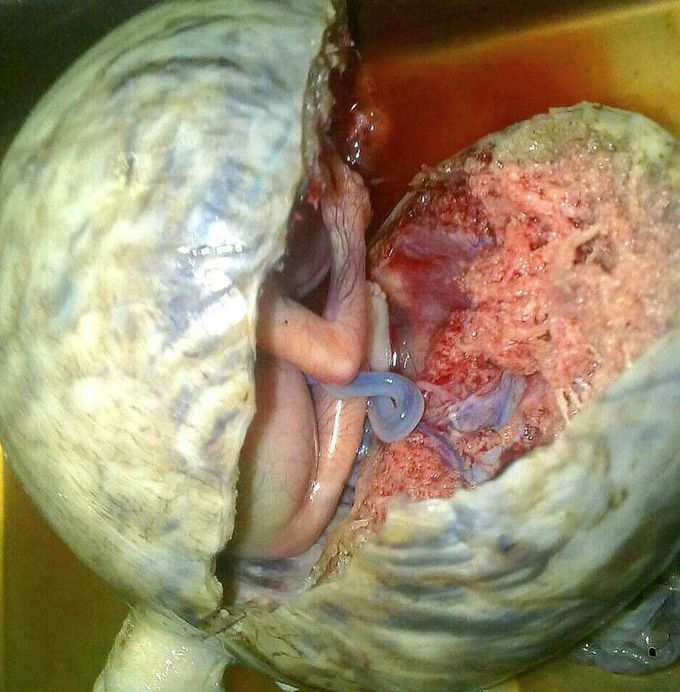 Ectopic pregnancy